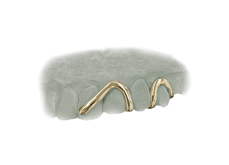 Top Wave Grillz (10K, Yellow Gold)