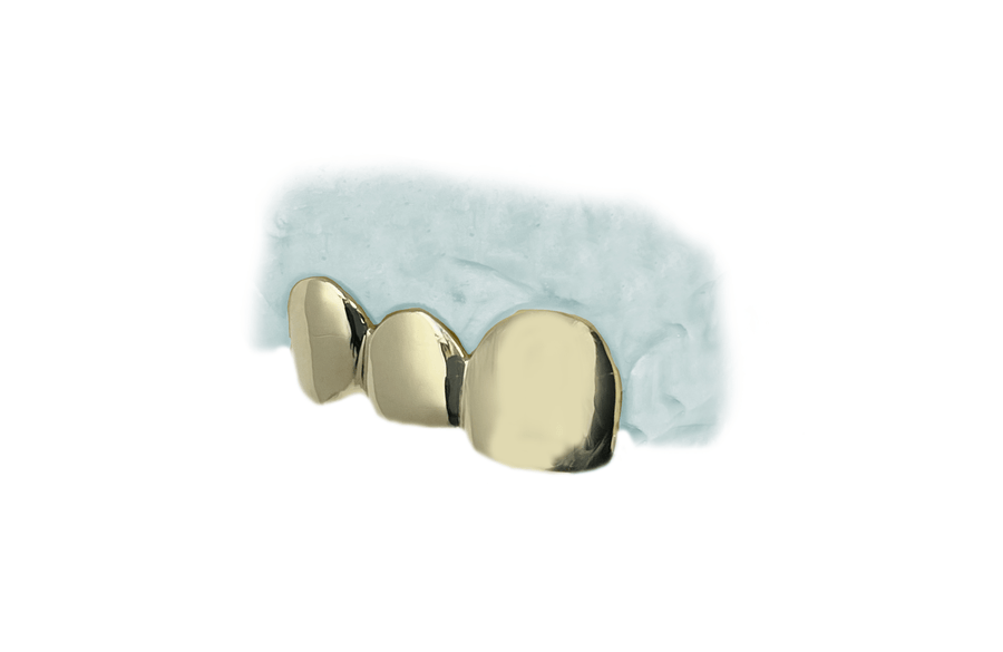 3 Tooth Gold Grillz in Yellow Gold